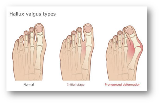 Hallux Valgus